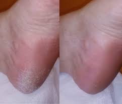 Removedor De Callos Electrico Flawless